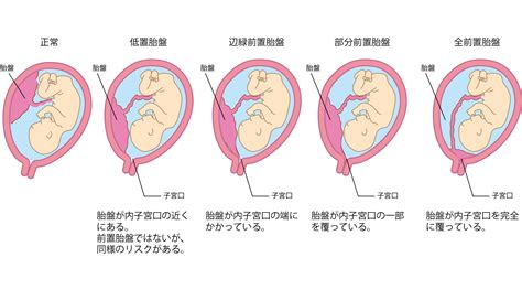 胎盤形成出血|(2)前置胎盤・癒着胎盤 – 日本産婦人科医会